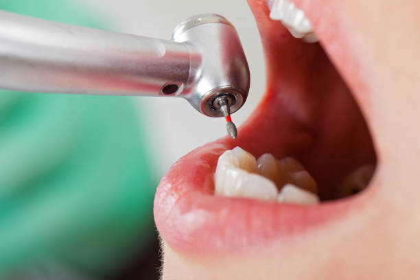 Best Root Canal Emergency Dentist  in Benton City, WA
